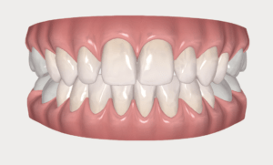 formation dentaire Invisalign go