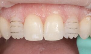 formation dentaire Invisalign go